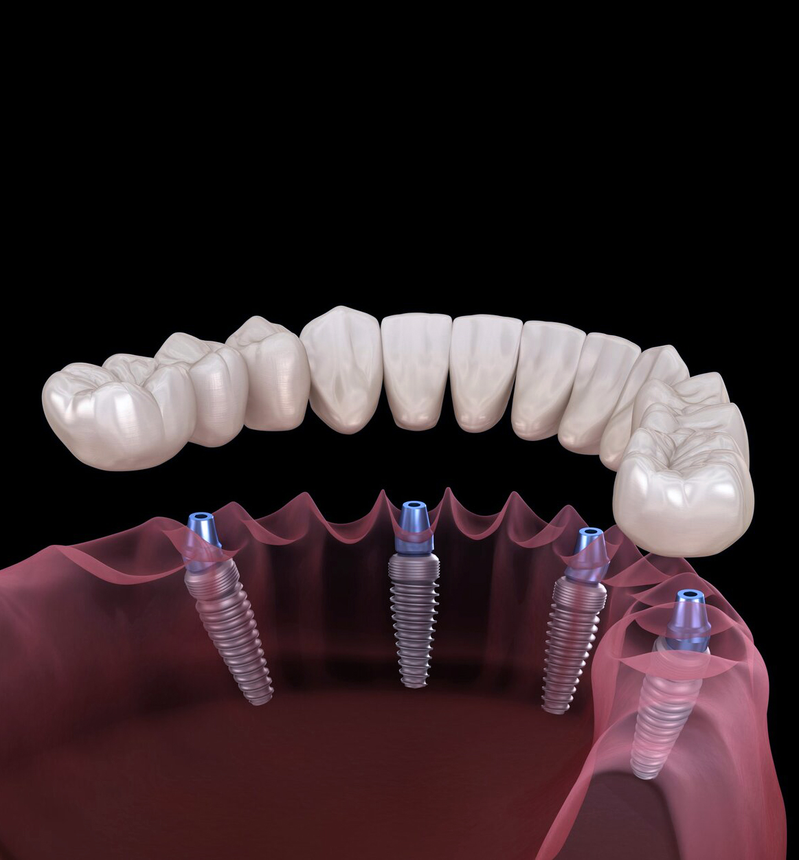 All-on-4 Implants and Blood Sugar Guide for Diabetics